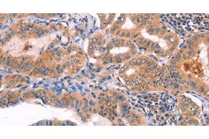 Immunohistochemistry of paraffin-embedded Human thyroid cancer using NCEH1 Polyclonal Antibody at dilution of 1:80 (NCEH1 anticorps)