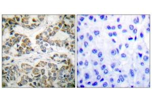 Immunohistochemical analysis of paraffin-embedded human breast carcinoma tissue using Shc (phospho-Tyr349) antibody. (SHC1 anticorps  (pTyr349))