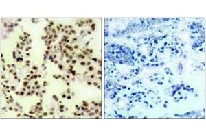 Immunohistochemistry analysis of paraffin-embedded human lung carcinoma, using p73 (Phospho-Tyr99) Antibody.