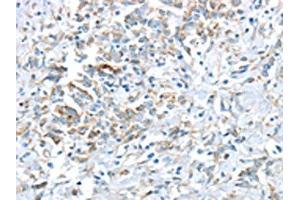 The image on the left is immunohistochemistry of paraffin-embedded Human gastric cancer tissue using ABIN7193036(VWCE Antibody) at dilution 1/30, on the right is treated with synthetic peptide. (VWCE anticorps)