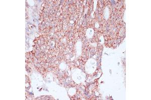 Immunohistochemistry of paraffin-embedded human colon carcinoma using RPL30 antibody (ABIN6130903, ABIN6147135, ABIN6147136 and ABIN6217777) at dilution of 1:100 (40x lens).