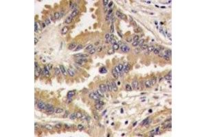 IHC analysis of FFPE human lung carcinoma tissue stained with Bad antibody (BAD anticorps  (AA 53-81))