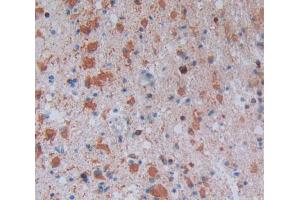 Used in DAB staining on fromalin fixed paraffin- embedded glioma tissue