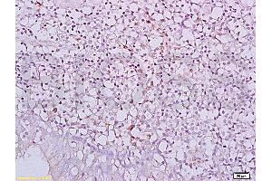 Formalin-fixed and paraffin embedded human nasopharyngeal carcinoma labeled with Anti-NKG2D/CD314/KLRK1 Polyclonal Antibody, Unconjugated (ABIN730078) at 1:200, followed by conjugation to the secondary antibody and DAB staining (KLRK1 anticorps  (AA 121-219))