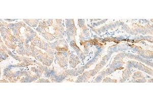 Immunohistochemistry of paraffin-embedded Human thyroid cancer tissue using CELA3A Polyclonal Antibody at dilution of 1:25(x200) (Elastase 3A anticorps)