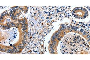 Immunohistochemistry of paraffin-embedded Human colon cancer tissue using EFNB2 Polyclonal Antibody at dilution 1:80 (Ephrin B2 anticorps)