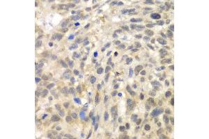 Immunohistochemistry of paraffin-embedded human esophageal cancer using TLK2 antibody at dilution of 1:100 (x40 lens). (TLK2 anticorps)