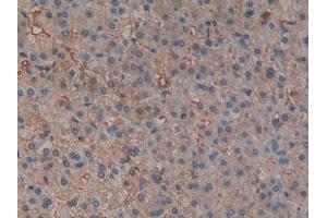 IHC-P analysis of Human Liver cancer Tissue, with DAB staining. (Hemoglobin Subunit beta anticorps  (AA 1-147))