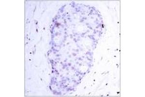 Immunohistochemistry analysis of paraffin-embedded human breast carcinoma, using NF-kappaB p105/p50 (Phospho-Ser907) Antibody.
