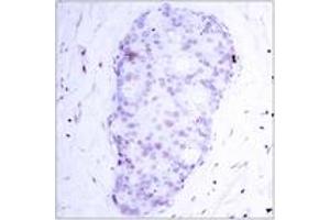 Immunohistochemistry analysis of paraffin-embedded human breast carcinoma, using NF-kappaB p105/p50 (Phospho-Ser907) Antibody. (NFKB1 anticorps  (pSer907))