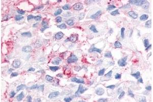 Anti-ESRRG / ERR3 antibody  ABIN1048586 IHC staining of human breast cancer. (ESRRG anticorps  (N-Term))