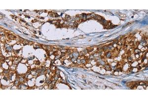 Immunohistochemistry of paraffin-embedded Human breast cancer using BMP6 Polyclonal Antibody at dilution of 1:50 (BMP6 anticorps)