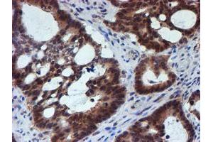 Immunohistochemical staining of paraffin-embedded Adenocarcinoma of Human colon tissue using anti-RUVBL2 mouse monoclonal antibody. (RUVBL2 anticorps  (AA 113-370))