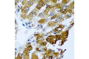 Immunohistochemical analysis of BLVRB staining in human liver cancer formalin fixed paraffin embedded tissue section. (BLVRB anticorps)