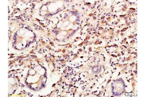 Formalin-fixed and paraffin embedded: human colon carcinoma labeled with Anti-Cyclin C Polyclonal Antibody, Unconjugated  at 1:300, followed by conjugation to the secondary antibody and DAB staining