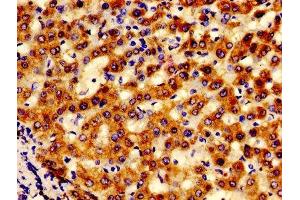 IHC image of ABIN7143578 diluted at 1:600 and staining in paraffin-embedded human liver cancer performed on a Leica BondTM system. (AFG1-Like ATPase (AFG1L) (AA 14-313) anticorps)