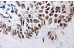 Immunohistochemistry (IHC) analyzes of ZIP-kinase antibody in paraffin-embedded human lung carcinoma tissue. (DAPK3 anticorps)