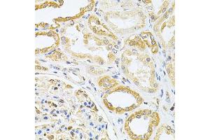 Immunohistochemistry of paraffin-embedded human kidney cancer using VAPB Antibody (ABIN1876551) at dilution of 1:200 (40x lens). (VAPB anticorps)
