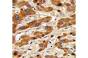IHC analysis of FFPE human hepatocarcinoma stained with Bax antibody