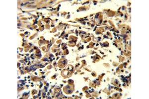 IHC analysis of FFPE human lung carcinoma stained with SOD3 antibody (SOD3 anticorps  (AA 7-36))