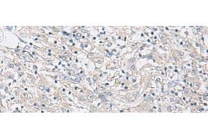 Immunohistochemistry of paraffin-embedded Human liver cancer tissue using FBXO16 Polyclonal Antibody at dilution of 1:60(x200) (FBXO16 anticorps)