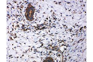 Anti-CD163 antibody, IHC(P): Human Mammary Cancer Tissue (CD163 anticorps  (AA 1056-1165))
