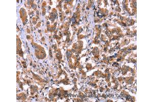 Immunohistochemistry of Human ovarian cancer using HRG Polyclonal Antibody at dilution of 1:50 (HRG anticorps)