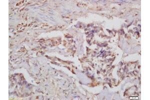Formalin-fixed and paraffin embedded human colon carcinoma labeled with Rabbit Anti-CARD15 Polyclonal Antibody, Unconjugated  at 1:200 followed by conjugation to the secondary antibody and DAB staining
