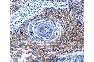 Immunohistochemistry of Human esophagus cancer using CLEC2B Polyclonal Antibody at dilution of 1:50 (CLEC2B anticorps)