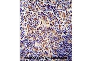 TIGD3 antibody (C-term) (ABIN654995 and ABIN2844630) immunohistochemistry analysis in formalin fixed and paraffin embedded human hodgkin lymphoma followed by peroxidase conjugation of the secondary antibody and DAB staining.