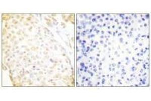 Immunohistochemistry analysis of paraffin-embedded human breast carcinoma tissue, using NKX3. (NKX3-1 anticorps  (N-Term))
