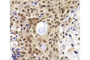 Immunohistochemistry of paraffin-embedded Human oophoroma using PHF19 Polyclonal Antibody at dilution of 1:100 (40x lens).