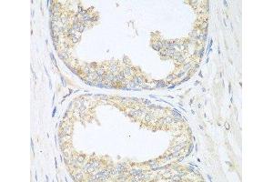 Immunohistochemistry of paraffin-embedded Human prostate using SGCB Polyclonal Antibody at dilution of 1:100 (40x lens). (SGCB anticorps)