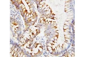 IHC-P: SPARC antibody testing of human intestinal cancer tissue