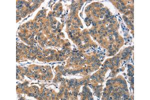 Immunohistochemistry of Human breast cancer using ALOX15 Polyclonal Antibody at dilution of 1:60