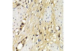 Immunohistochemistry of paraffin-embedded human stomach cancer using UAP1 antibody at dilution of 1:200 (400x lens). (UAP1 anticorps)