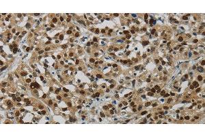 Immunohistochemistry of paraffin-embedded Human esophagus cancer tissue using DNA Ligase1 Polyclonal Antibody at dilution 1:70 (LIG1 anticorps)
