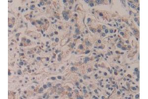 IHC-P analysis of Human Prostate cancer Tissue, with DAB staining. (APBA2 anticorps  (AA 459-722))