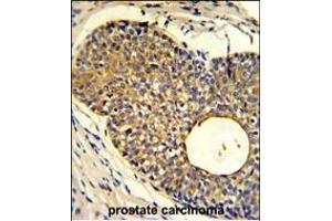 Formalin-fixed and paraffin-embedded human prostate carcinoma reacted with PHO1 Antibody (N-term), which was peroxidase-conjugated to the secondary antibody, followed by DAB staining. (Phosphate Transporter PHO1 (AA 1-30), (N-Term) anticorps)