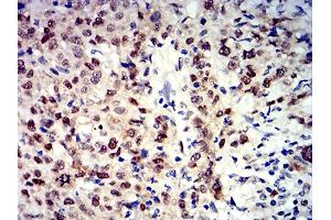 Immunohistochemical analysis of paraffin-embedded breast cancer tissues using APEX1 mouse mAb with DAB staining. (APEX1 anticorps  (AA 219-318))