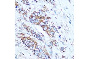 Immunohistochemistry of paraffin-embedded Human breast cancer using GSTT1 Rabbit pAb (ABIN3021870, ABIN3021871, ABIN3021872, ABIN1512971 and ABIN6216656) at dilution of 1:100 (40x lens). (GSTT1 anticorps  (AA 1-240))