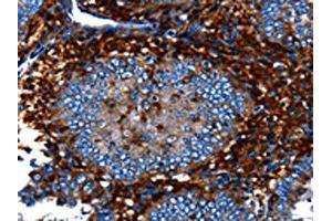 The image on the left is immunohistochemistry of paraffin-embedded Human cervical cancer tissue using ABIN7128981(CNGA2 Antibody) at dilution 1/25, on the right is treated with fusion protein. (CNGA2 anticorps)