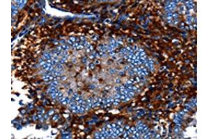 The image on the left is immunohistochemistry of paraffin-embedded Human cervical cancer tissue using ABIN7128981(CNGA2 Antibody) at dilution 1/25, on the right is treated with fusion protein.