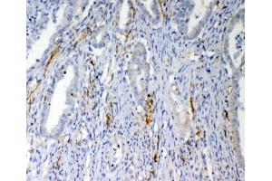 IHC testing of FFPE human colon cancer tissue with VEGFD antibody at 1ug/ml. (VEGFD (VEGF4) (AA 89-205) anticorps)