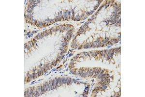 Immunohistochemistry of paraffin-embedded human rectal cancer using TPM2 antibody.