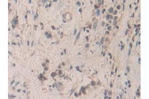 Detection of SMC3 in Human Stomach cancer Tissue using Polyclonal Antibody to Structural Maintenance Of Chromosomes Protein 3 (SMC3)