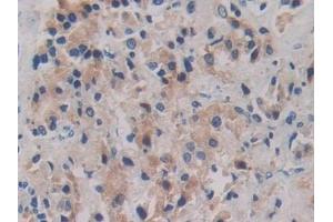 Detection of ROS1 in Human Prostate cancer Tissue using Polyclonal Antibody to C-Ros Oncogene 1, Receptor Tyrosine Kinase (ROS1) (ROS1 anticorps  (AA 1945-2222))