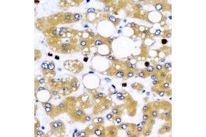 Immunohistochemical analysis of NFS1 staining in human liver cancer formalin fixed paraffin embedded tissue section. (NFS1 anticorps)