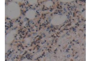 Detection of F1+2 in Human Skin cancer Tissue using Polyclonal Antibody to Prothrombin Fragment 1+2 (F1+2)