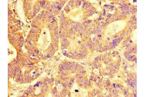 Immunohistochemistry of paraffin-embedded human colon cancer using ABIN7151966 at dilution of 1:100 (SLC29A1 anticorps  (AA 228-291))